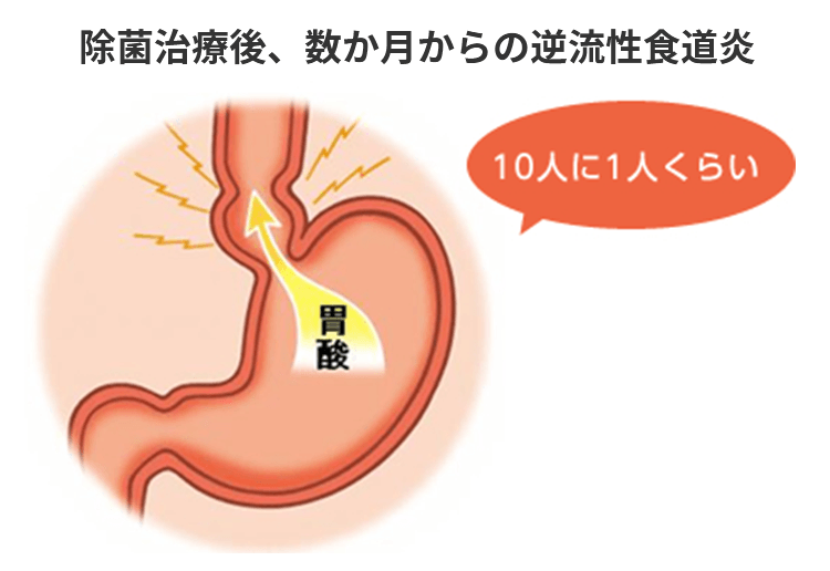 除菌治療後、数か月後からの逆流性食道炎は10人に1人くらいです